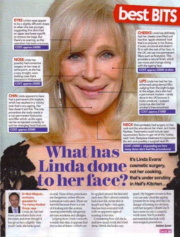 Linda Evans is the first to admit that she has had bad plastic surgery 